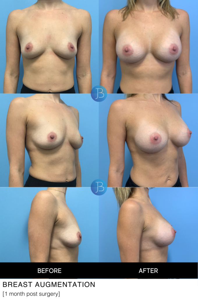 Breast Augmentation 10