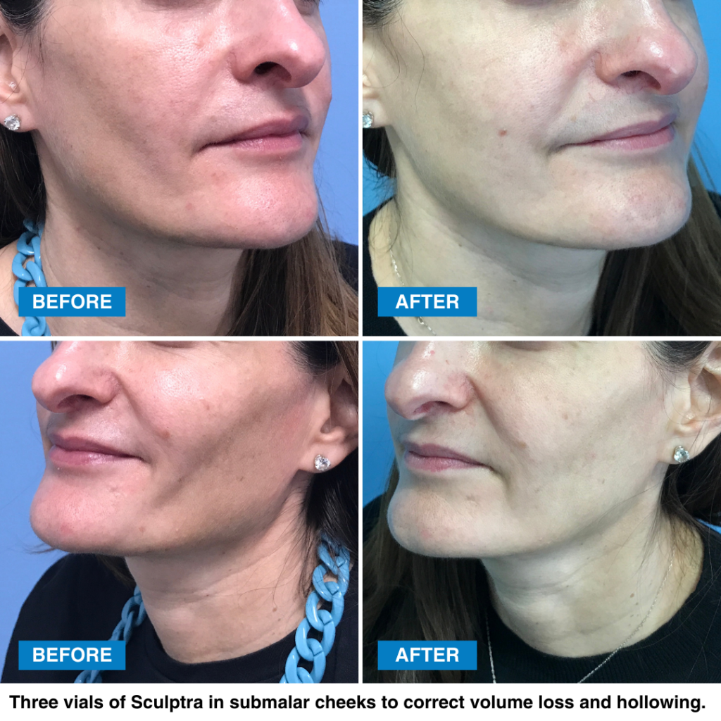 Before and after photos of Sculptra on a female patient