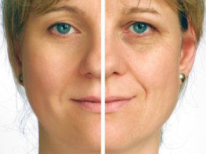 Botox Before & After Photos | Jacob Bloom, MD