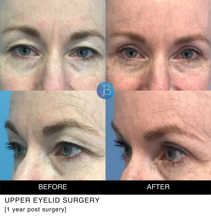 Female Blepharoplasty 1