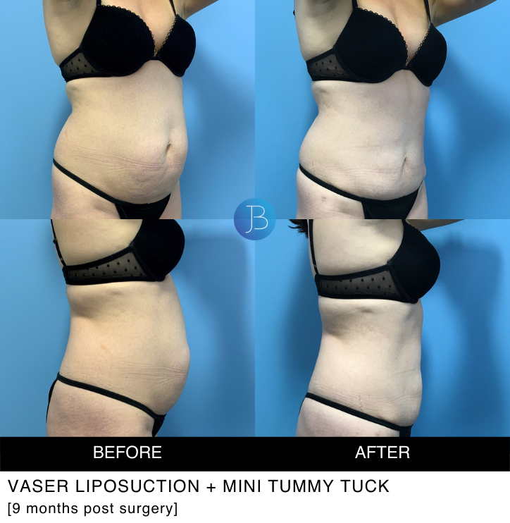 Abdominoplasty 2