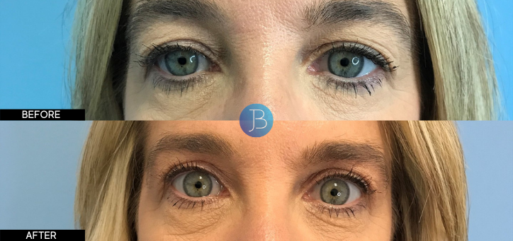 Blepharoplasty 7