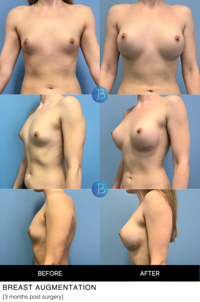 Breast Augmentation 3