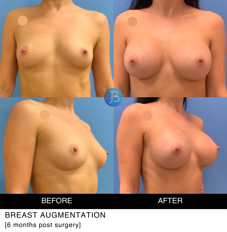 Breast Augmentation by Bloom Plastic Surgery