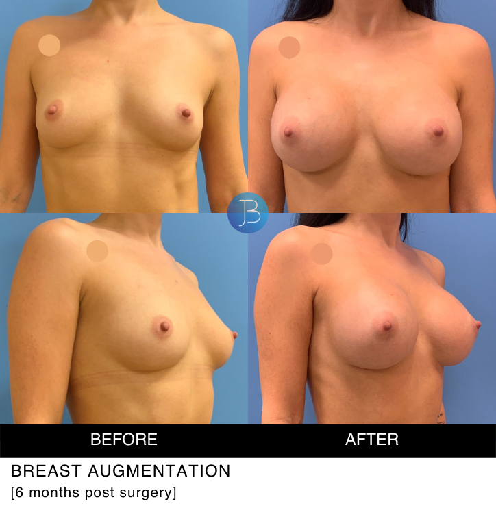 Breast Augmentation 7