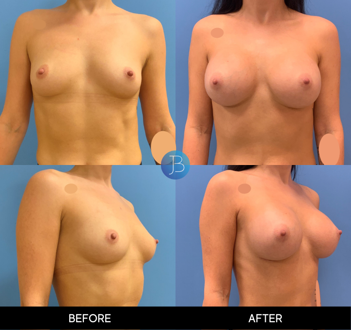 Breast Augmentation 7