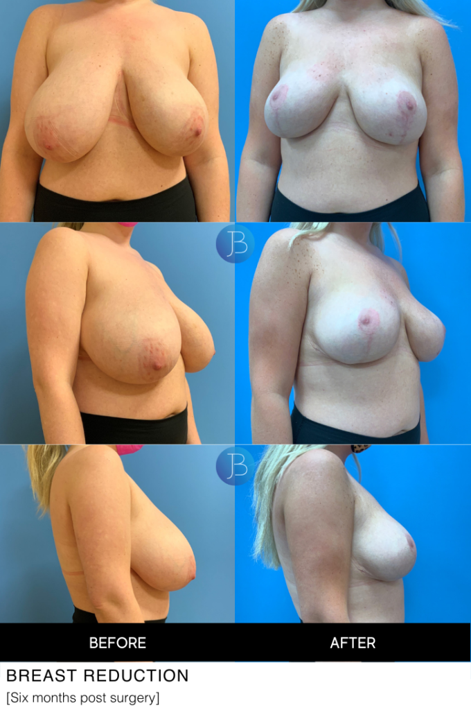 Breast Reduction 3