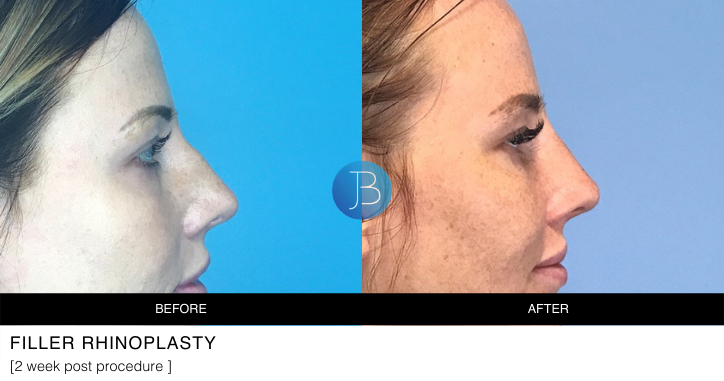 Filler Rhinoplasty 2