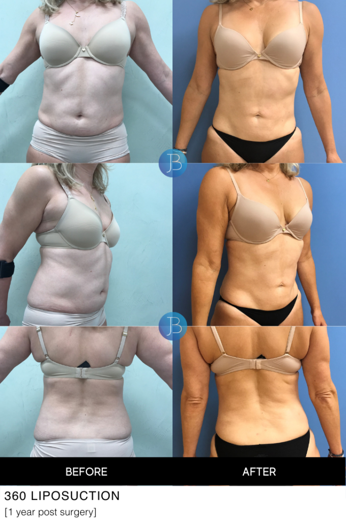 Liposuction