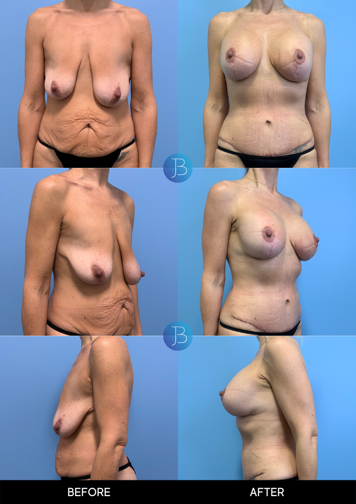 Before and after tummy tuck and breast lift following a Mommy Makeover done by Dr. Bloom in Chicago