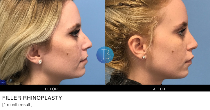 Filler Rhinoplasty 3