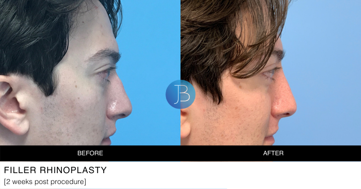 Filler Rhinoplasty 4