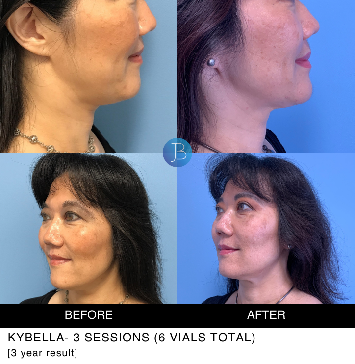 Kybella 1