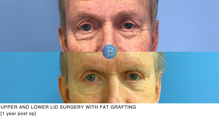 Male Blepharoplasty 2