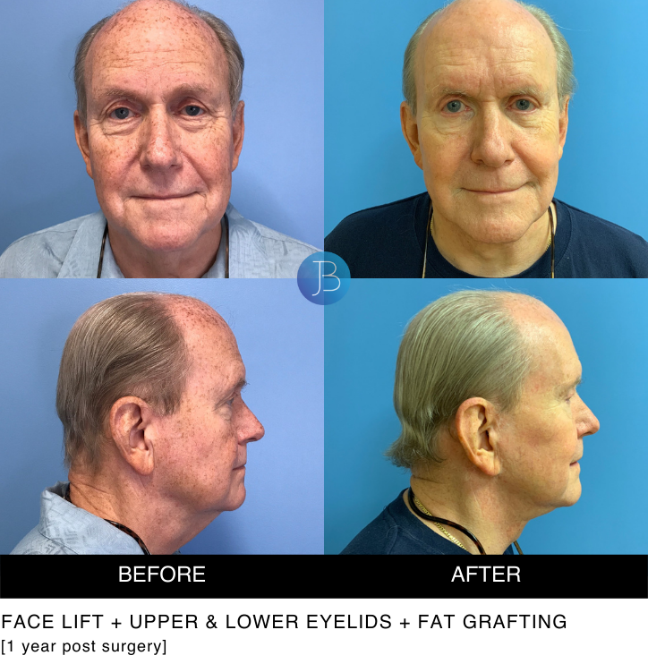 Male Facelift 2