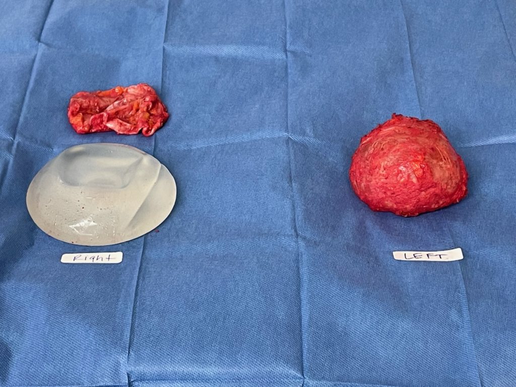 encapsulated implant formed by capsular contracture