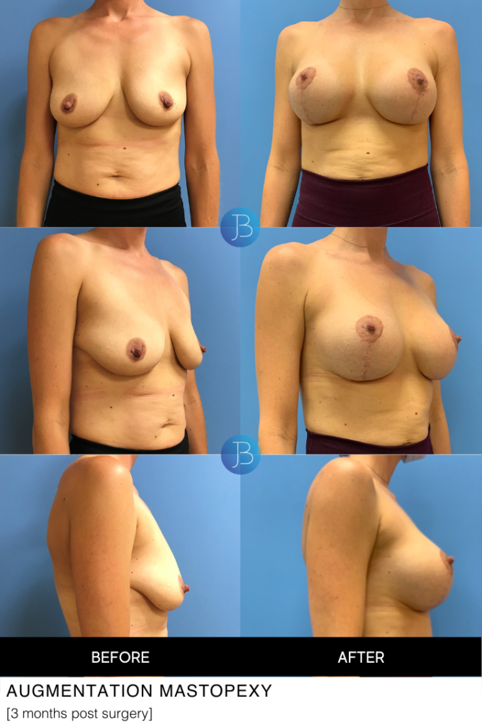 Augmentation Mastopexy 2