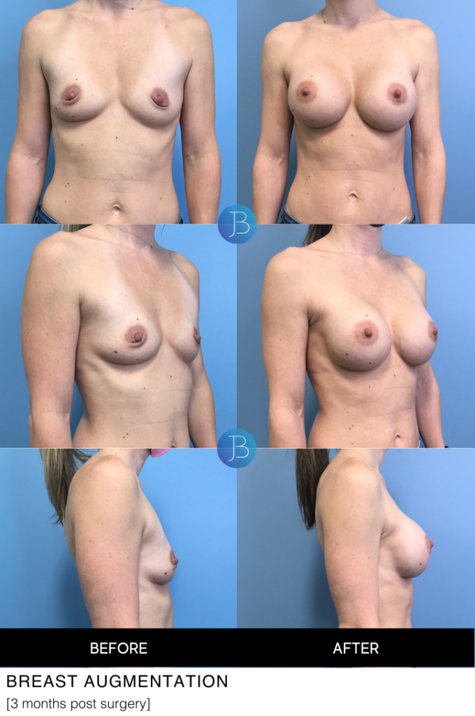 Breast Augmentation 9