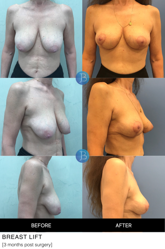 Breast Lift 2