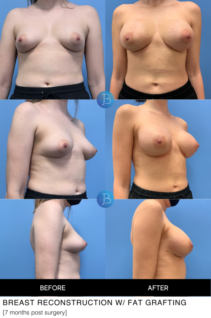 Breast Reconstruction with fat grafting
