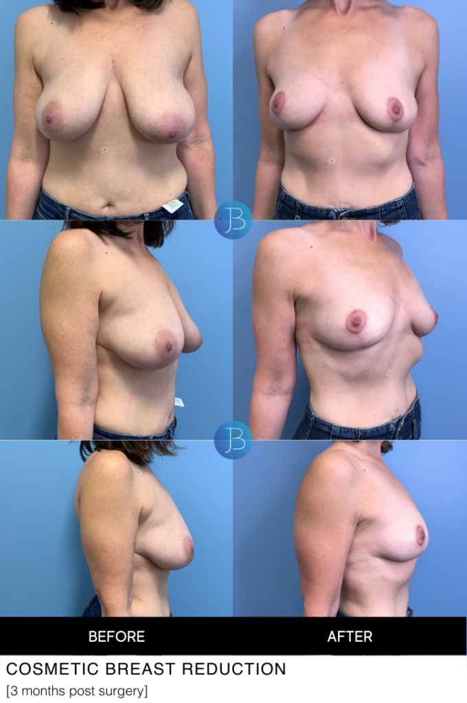 Cosmetic Breast Reduction 1
