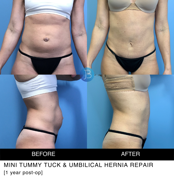 Tummy Tuck 4