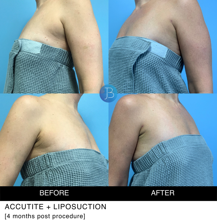 Accutite and Liposuction 4 months post procedure