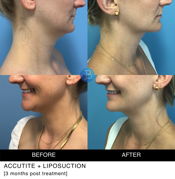 Accutite + Liposuction 3 months post treatment