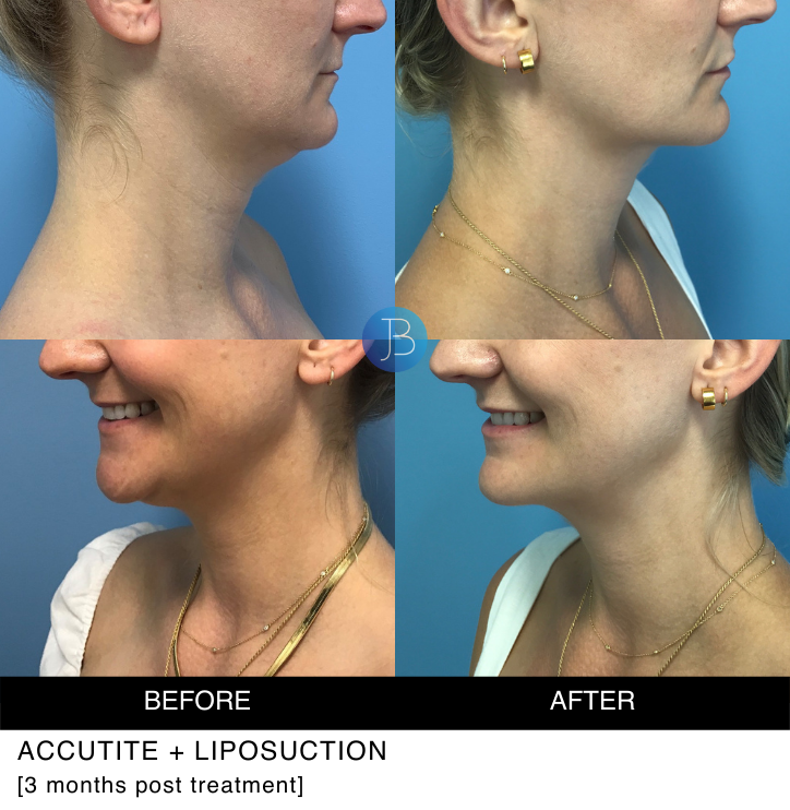 AccuTite before and after