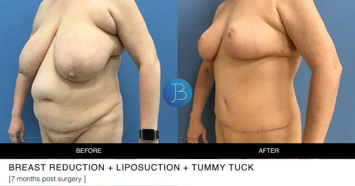 Breast reduction, Liposuction, Tummy Tuck - 7 months post surgery