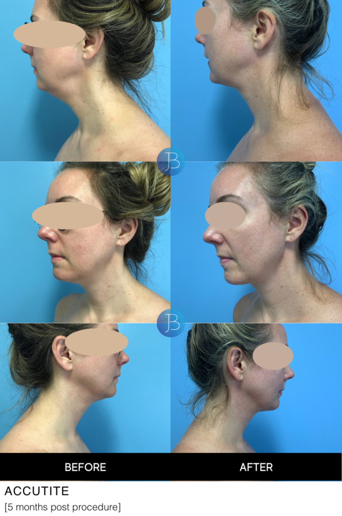 Accutite 5 months post procedure