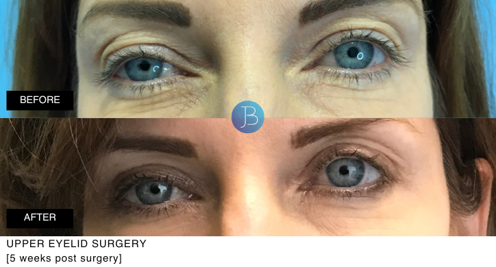 Upper and Lower Eyelid Surgery 5 months post surgery