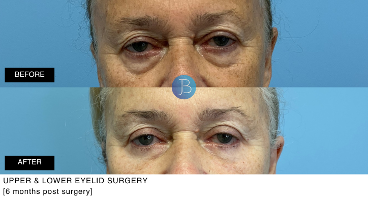 Upper and Lower Eyelid Surgery 6 months post surgery