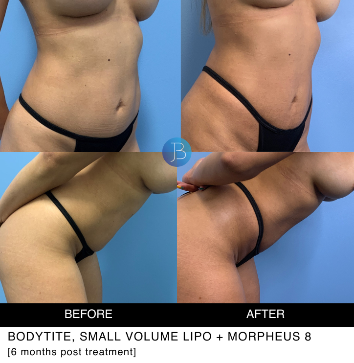 Bodytite Small volume lipo and Morpheus 8 - 6 months post treatment