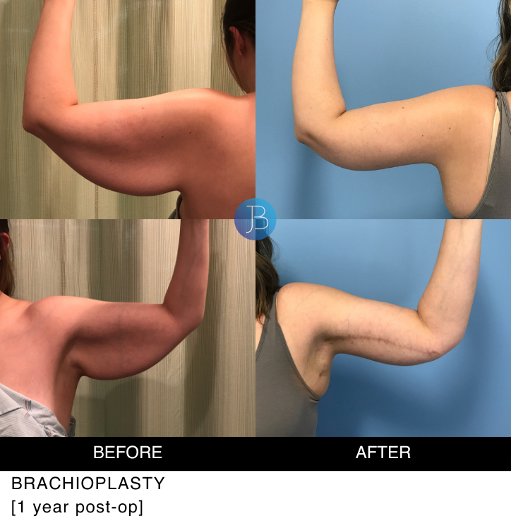 Brachioplasty 1 year post surgery