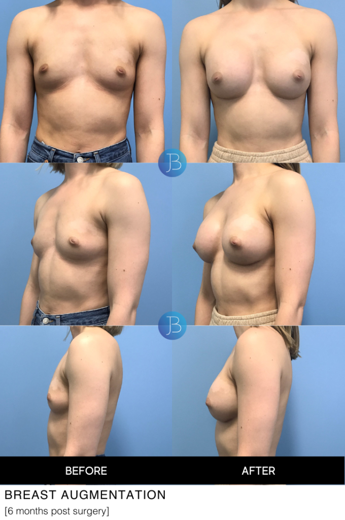 Breast augmentation 6 months post surgery