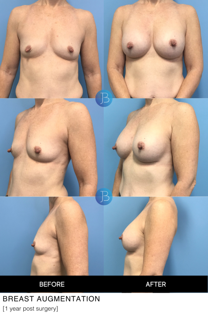 Breast augmentation 1 year post surgery