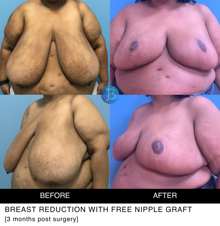 Breast reduction with free nipple graft 3 months post surgery