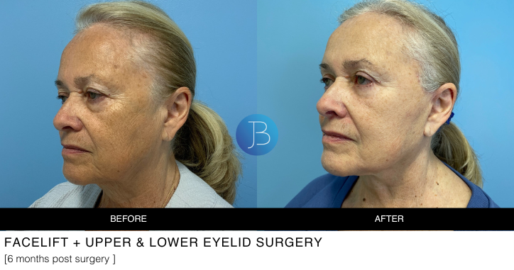 Facelift and upper & lower eyelid surgery 6 months post surgery