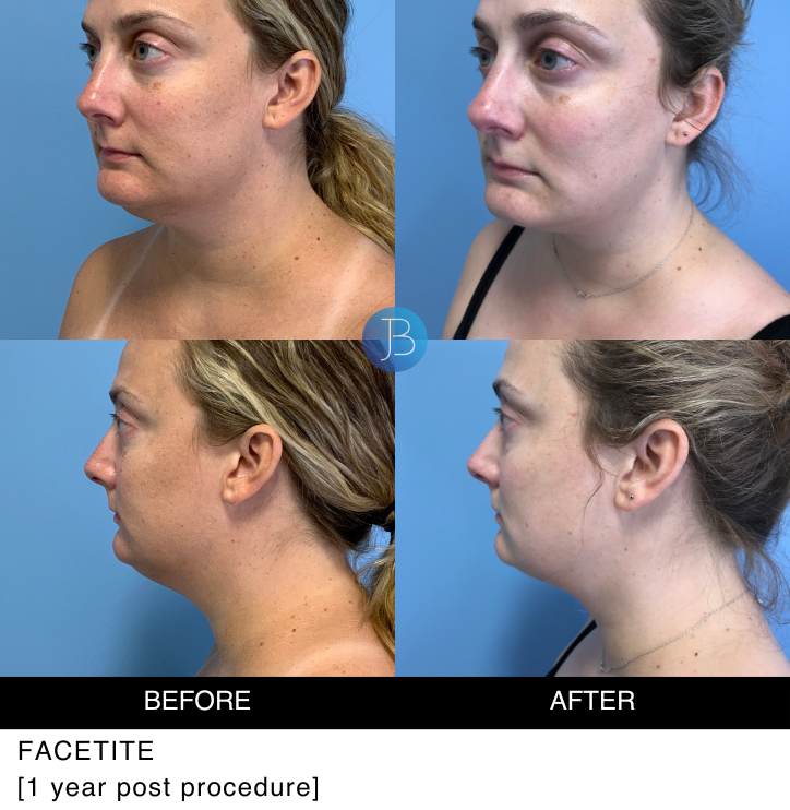 Facetite 1 year post procedure