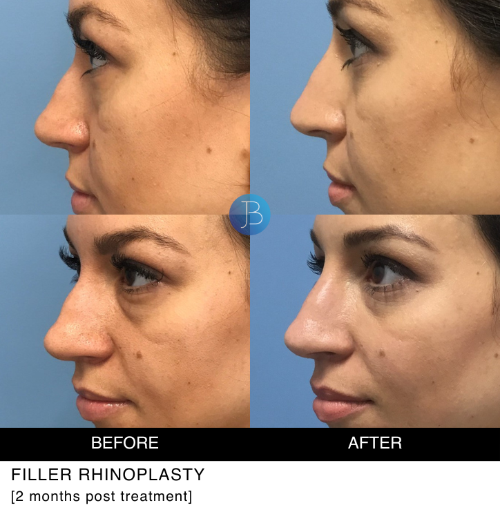 Filler Rhinoplasty 2 months post treatment