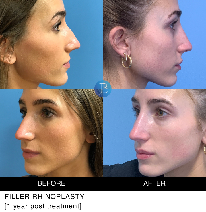 Filler Rhinoplasty 1 year post treatment