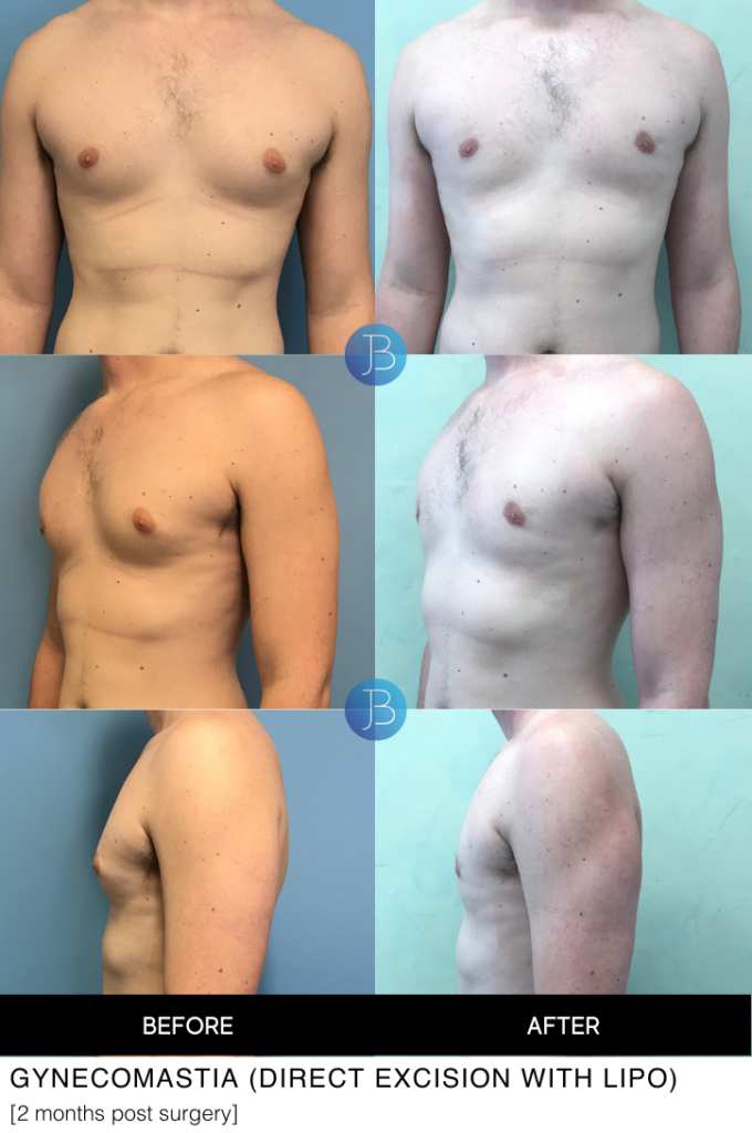 Gynecomastia 2 months post surgery