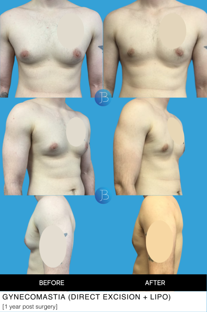 Gynecomastia 1 year post surgery