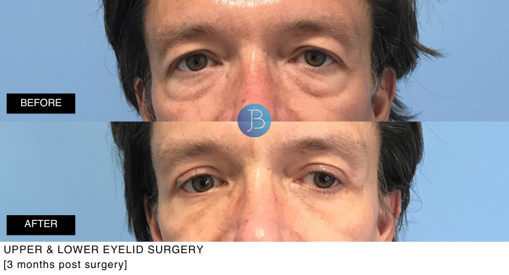 Upper and Lower Eyelid Surgery by Bloom Plastic Surgery