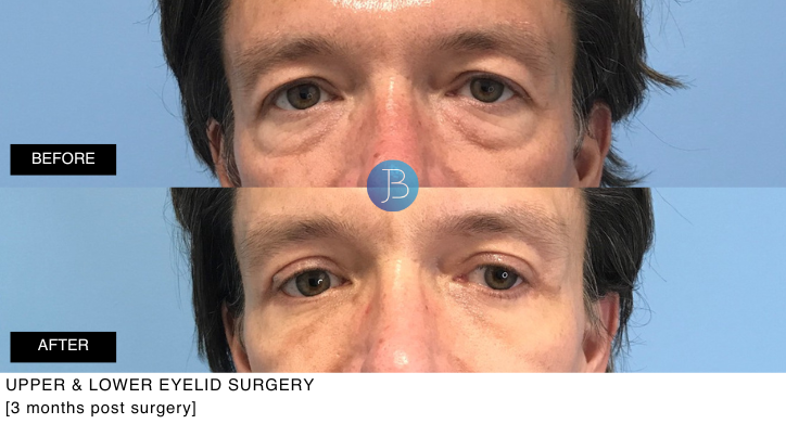 Upper and Lower Eyelid Surgery 3 months post surgery