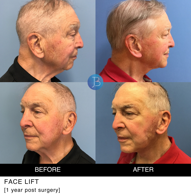 Face lift 1 year post surgery