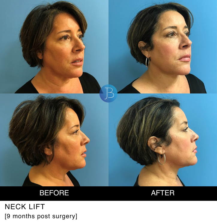 Neck Lift 9 months post surgery