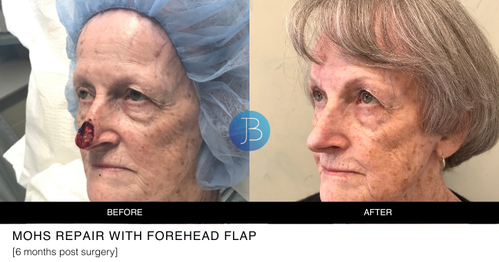 MOHS repair with forehead flap 6 months post surgery