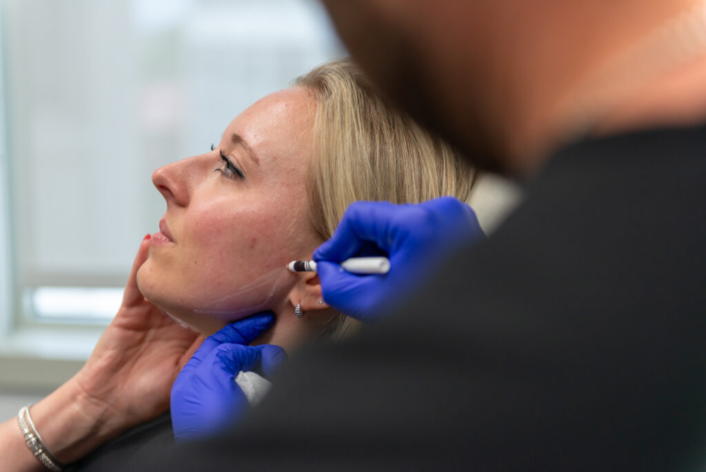 Chicago Plastic Surgeon Dr. Bloom face mapping for masseter Botox